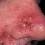 965ccb4839ff8a12510409ce545f72c3 1 - Фурункул в носу: причины появления и симптомы фурункулеза, фото, как лечить чирей