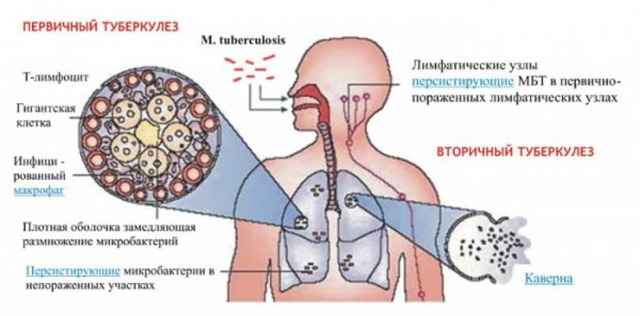 967e00ccf6e486a8d5d9f237cac1a0cb 1 - Признаки туберкулёза лёгких на ранних стадиях у взрослого человека