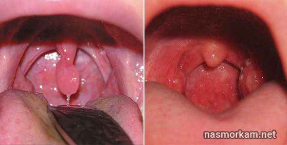 98dad473fea3724befc5c139cfce9468 1 - Отечность небного язычка в горле (увулит): причины, из-за чего он может увеличиваться, симптомы и лечение