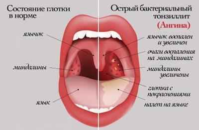 9950a463a69029621c5b7061acda4eae 1 - Мирамистин при боли в горле: инструкция для взрослых, как полоскать горло мирамистином