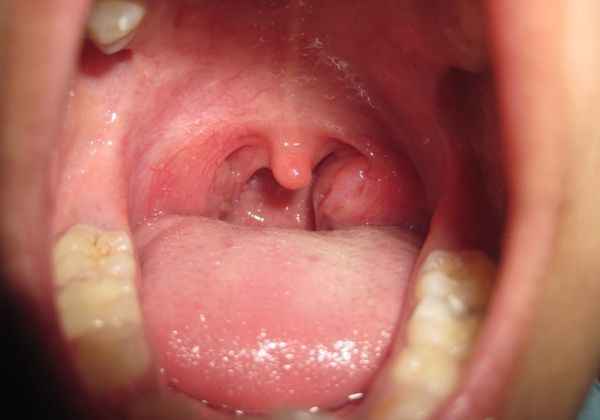 9d6523b1a4939440867230b848751789 1 - Миндалины: как выглядят здоровые миндалины в горле, воспаление миндалин, лечение горла