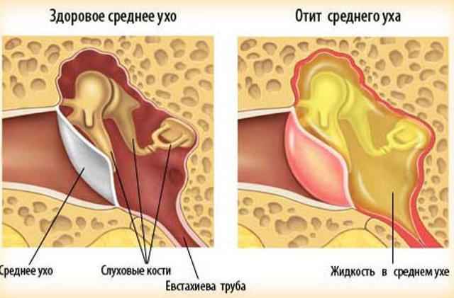 9df058c0b8b503e91c521795b1f97589 1 - Заложенность уха при насморке: причины, лечение, профилактика