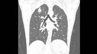 9f9185dfe3f000eda50b74f549461d7a 1 - Что такое туберкулома лёгких: заразна или нет, симптомы и последствия, лечение с помощью народных средств
