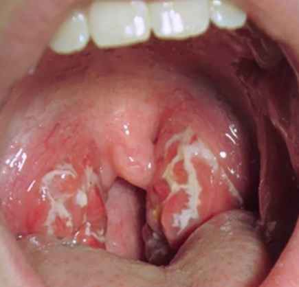 9fbfeb08269b6c7a0ab1d6be28a91f1a 1 - Миндалины: как выглядят здоровые миндалины в горле, воспаление миндалин, лечение горла