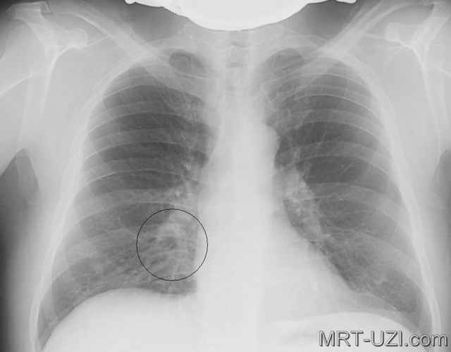 a0d2a6bdae8ef14047c3a3d632bd7270 1 - Пневмония на рентгеновских снимках: различия признаков для разных форм болезни на рентгене и фото