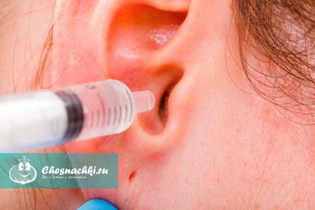 a24d4c8aef19c824fb0f5866f4a9a341 1 - Как удалить ушную пробку самостоятельно: польза ушной серы, причины и признаки, удаление из уха и профилактика