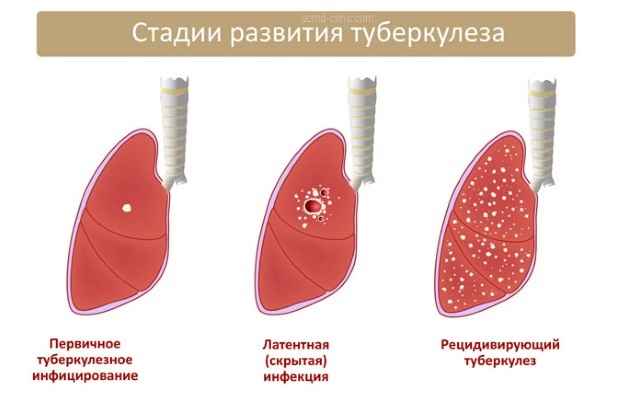 a2bc38fd4c11d9825628183fba126618 1 - Что такое туберкулома лёгких: заразна или нет, симптомы и последствия, лечение с помощью народных средств