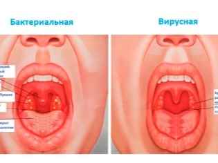 a3ab11511b06b3acac12970856215513 1 - Красное горло у ребенка: как определить болезнь и чем ее лечить