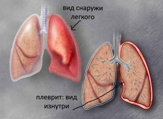 a3c757e8947e29602fd963b64b463569 1 - Плеврит лёгких: особенности, симптомы, а также лечение и профилактика воспаления