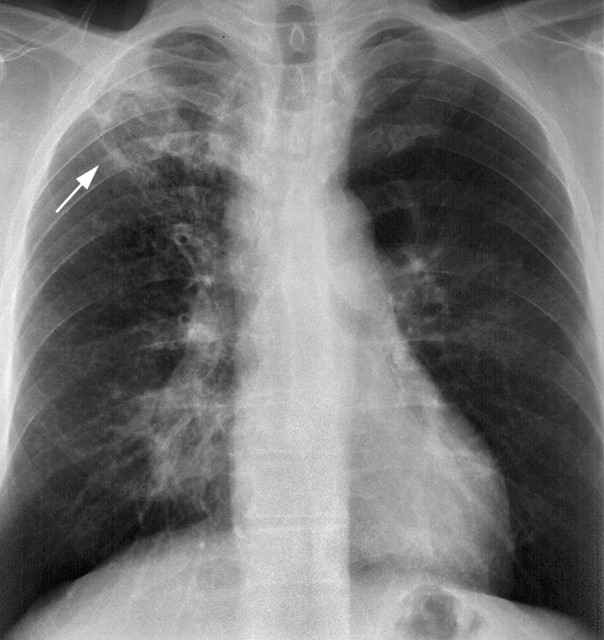 a5b111a25a61ef933425895c4e8007a4 1 - Признаки туберкулёза лёгких на ранних стадиях у взрослого человека