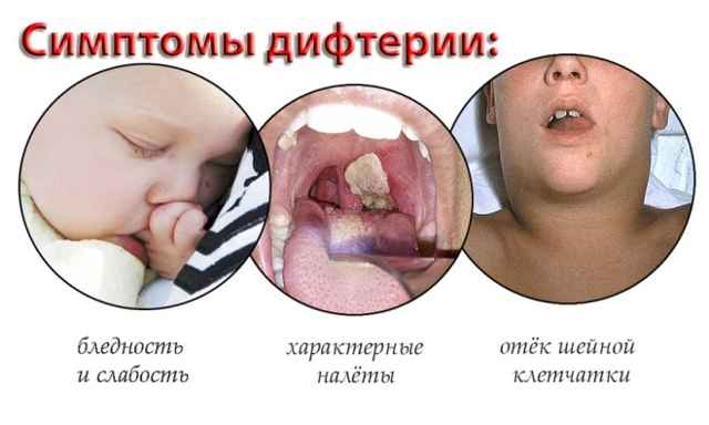 a8d34b0c6f07b902b7856a4372607d64 1 - Почему может образоваться белый налёт в горле на гландах и миндалинах у взрослого или ребёнка?