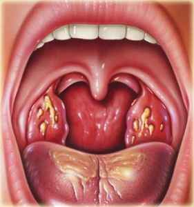 aa0d995212e60ad1c785fbcb9e5ad743 1 - Боль в горле: чем лечить сильную боль при глотании, как убрать болезненные ощущения, что помогает?