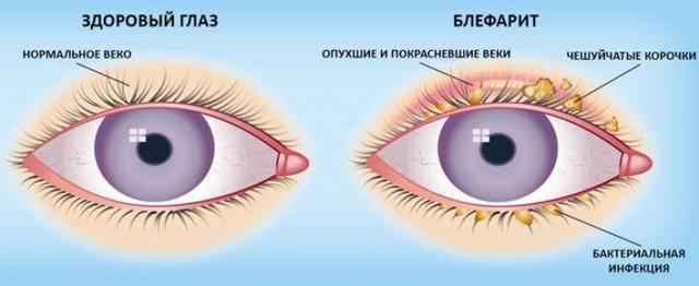 abad9446f6b39ff2587c9a9f9212d2b5 1 - Как применять глазные капли офлоксацин: показания и противопоказания, инструкция по применению капель, цена