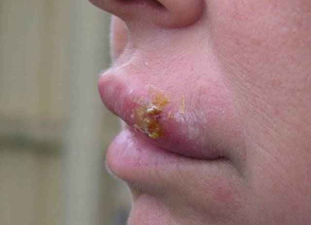 ad6c4f12f95ca45ff73190c555abf08c 1 - Как избавиться от простуды на губах? чем лечить быстро и простуду на губах?