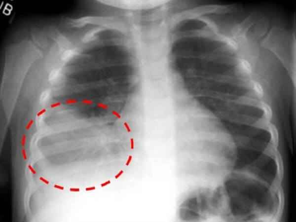 ae12018bab056491be9dc8b1e4fd0a77 1 - Правосторонняя пневмония: причины воспаления легких справа, лечение верхнедолевой и нижнедолевой пневмонии
