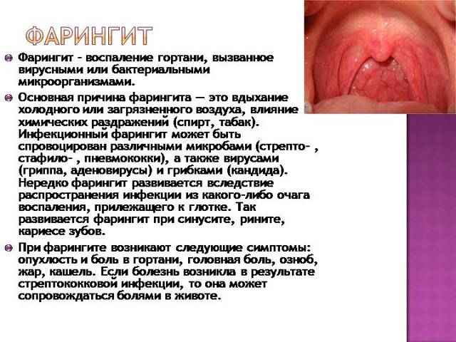 ae7b306ce840eee92f94aad524375c86 1 - Фолликулярная ангина – это инфекционное заболевание, которое проявляется в виде воспаления небных миндалин