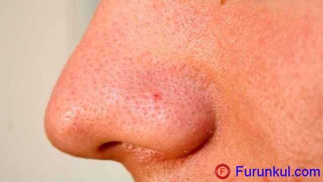 b1c8e4f1391ab1aff36d2f7978ba8ad3 1 - Фурункул в носу: причины появления и симптомы фурункулеза, фото, как лечить чирей