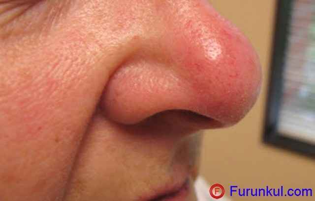 b1c98c8e651973d03b6d4648e434312d 1 - Фурункул в носу: причины появления и симптомы фурункулеза, фото, как лечить чирей
