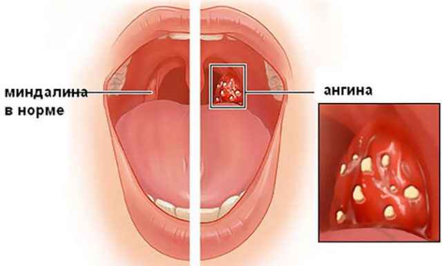 b1f0a98113ebb31adf53bf6c6cbc683f 1 - Миндалины в горле: основные причины, симптомы и лечение воспаления глоточных и небесных миндалин