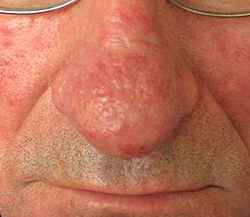 b23ba642d61eb54e78eb783dc11b96de 1 - Ринофима носа — симптомы, лечение и профилактика заболевания