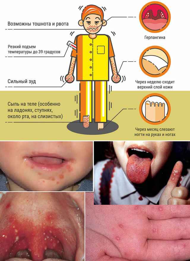b2f6f75ce32d5047f0c130112110a96b 1 - Проявления вируса коксаки у детей и взрослых: симптомы, трудности диагностики, особенности лечения