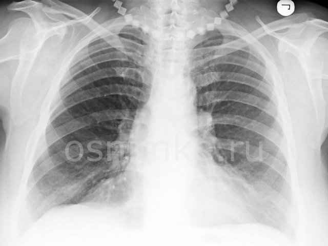 b30a9751d2616dc60c4ba373d1f197b6 1 - Пневмония на рентгеновских снимках: различия признаков для разных форм болезни на рентгене и фото