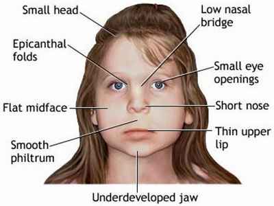 b312a09fd0bd917c88dc44ac57ee4cb8 1 - Аденоидный тип лица у ребёнка, где находиться и как выглядит, фото
