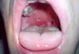 b3a78f165f223a8b0bdb58995f9cf412 1 - Что такое абсцесс в горле, его типы и симптомы, лечение абсцессов