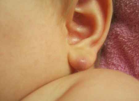 b4149dfcd51d0fd884fe7d8a611c099f 1 - Шарик на мочке уха: что это такое, причины образования такого уплотнения, почему болит такая шишка?