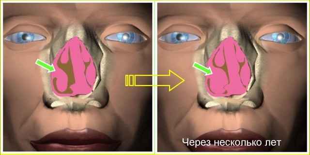 b548a9fda99076cbcd6a73e0e538d762 1 - Если появились зеленые сопли у взрослого: как избавиться от них, чем лечить заложенный нос