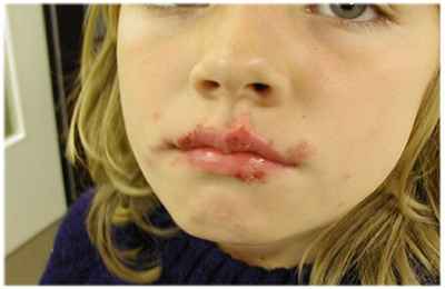 b70dd3ec1080bf000dbb0592d2166abf 1 - Герпесная инфекция у детей: симптомы и последствия заражения
