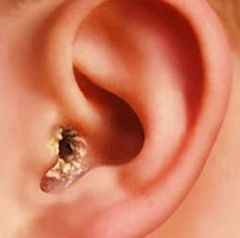 b84a3d516fdb3cf6e957e80bf198e013 1 - Корочки в ушах, сухие уши и шелушение ушей: причины и методы избавления