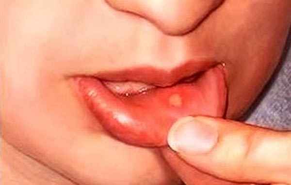 b9aef14a2fc6eb8d983f95ca1ca522a7 1 - Гнойные язвочки во рту и причины их появления, а также виды болячек полости рта и их лечение