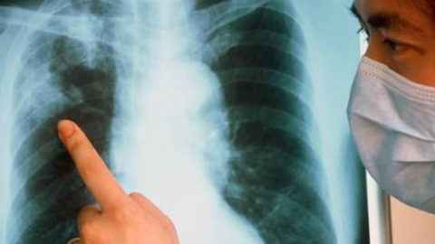 ba1f3d0b6c33f52092ff7be6c90b9529 1 - Признаки туберкулёза лёгких на ранних стадиях у взрослого человека