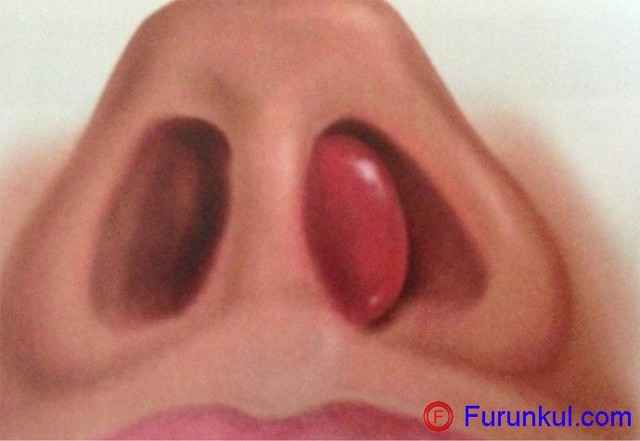 ba2aedfb1f12f1696c8fa736b0ff9209 1 - Фурункул в носу: причины появления и симптомы фурункулеза, фото, как лечить чирей
