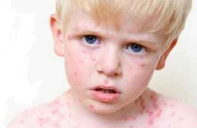 c2d53f3939ca57d7f2e77203a30dc177 1 - Герпесная инфекция у детей: симптомы и последствия заражения