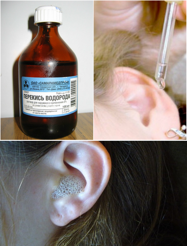 Почистить уши перекисью водорода в домашних условиях. Пероксид водорода для ушей. Водорода пероксид капли в уши.