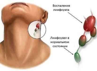 c73c3d7ce62def4cf6dfb3dc4977e57d 1 - Шарик на мочке уха: что это такое, причины образования такого уплотнения, почему болит такая шишка?