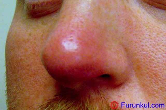 c79b9ee1a63fb5acbf254d094ccb5248 1 - Фурункул в носу: причины появления и симптомы фурункулеза, фото, как лечить чирей