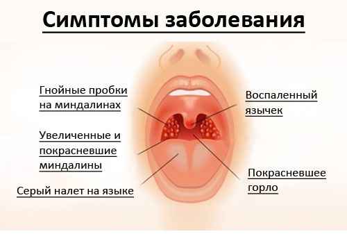c976c341f885c2e6a14612ff0bfa5989 1 - Что такое абсцесс в горле, его типы и симптомы, лечение абсцессов