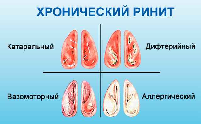 c9ddce8eba415b5195bae3fe3bf498d9 1 - Симптомы воспаления слизистой оболочки носа: в чем заключается лечение