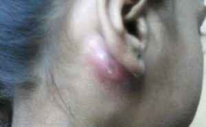 cd34b1793795a5cbed9cc4ffbee37b4b 1 - Воспалился лимфоузел за ухом: что это за опухоль, почему он может воспаляться, лечение недуга