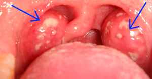 d00a2a666e2d323501613f0a06e0ac8a 1 - Почему может образоваться белый налёт в горле на гландах и миндалинах у взрослого или ребёнка?