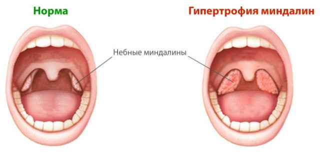 d016b1f658c6430f2933a1c78a816468 1 - Миндалины: как выглядят здоровые миндалины в горле, воспаление миндалин, лечение горла