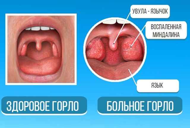 d1d9e7d278737d54587866c8209e0b9b 1 - Отечность небного язычка в горле (увулит): причины, из-за чего он может увеличиваться, симптомы и лечение