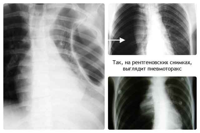 d236bf9ca4d4fdb59eca5abaf60e4702 1 - Пневмония на рентгеновских снимках: различия признаков для разных форм болезни на рентгене и фото