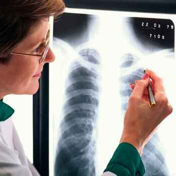 d2fc8f4563c4215d64eba8897c499036 1 - Пневмония на рентгеновских снимках: различия признаков для разных форм болезни на рентгене и фото