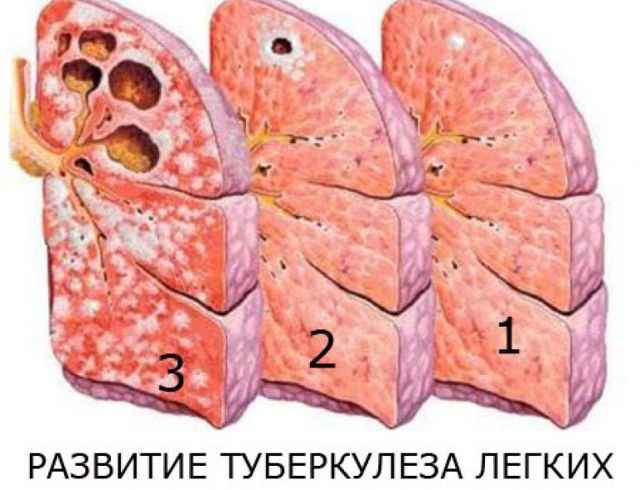 d39fb223a282f5d92a11a882b3c991b6 1 - Можно ли вылечить туберкулёз полностью? какими средствами следует лечиться