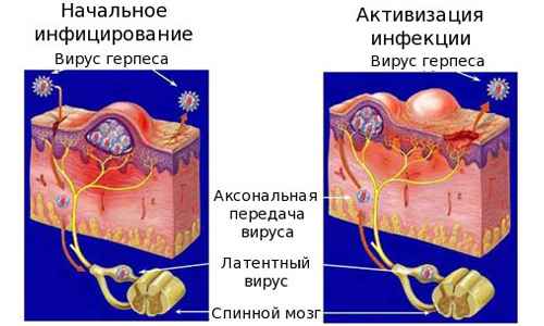 d74c8511748a9a1a53e0b67a5da2aeac 1 - Герпес в носу: симптомы заболевания, методы лечения, мази от герпеса