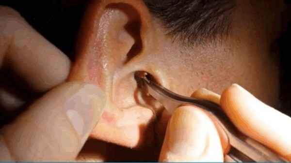d799cff2aecaff8804fb2420c6c00afd 1 - Как удалить ушную пробку самостоятельно: польза ушной серы, причины и признаки, удаление из уха и профилактика
